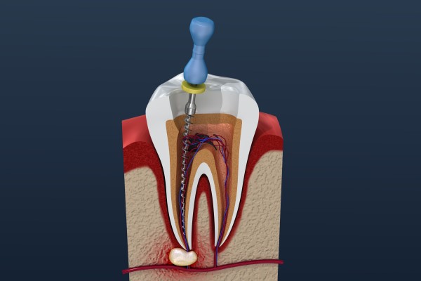 What Is An Endodontist